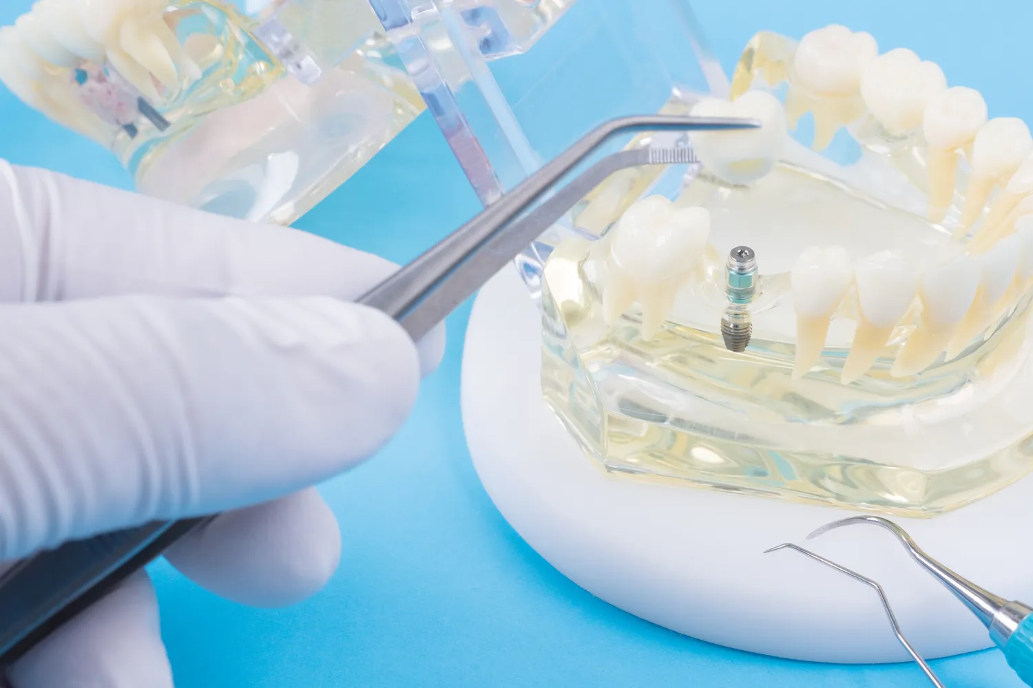 Ile kosztują implanty dla seniorów?